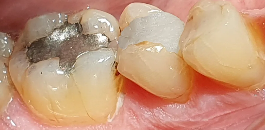 Zahnfüllungen Amalgam und Zement
